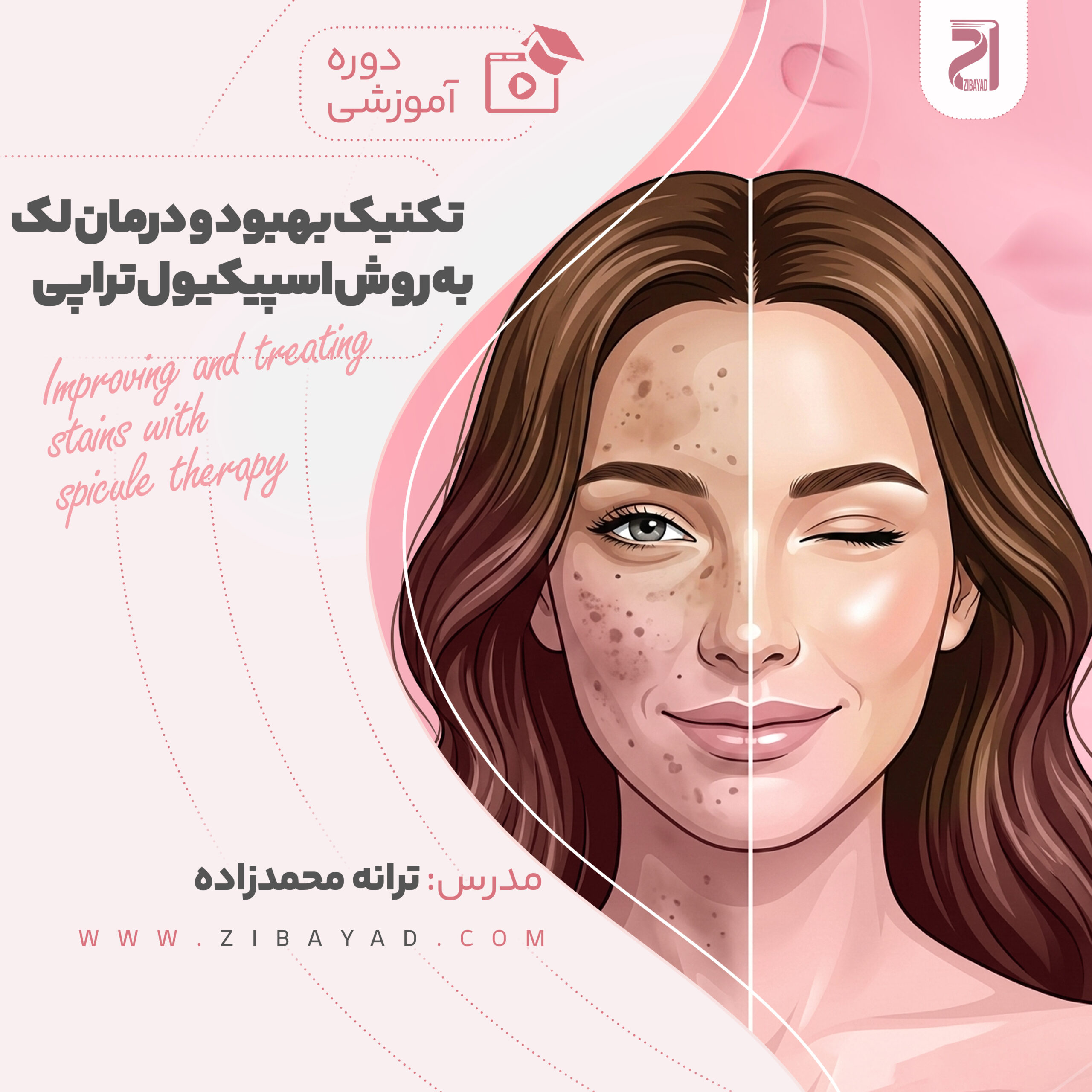 دوره ی تکنیک بهبود و درمان لک به روش اسپیکیول تراپی (ترانه محمدزاده)